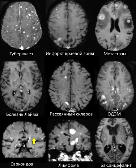 МРТ при поражении головного мозга боррелиозом снимок