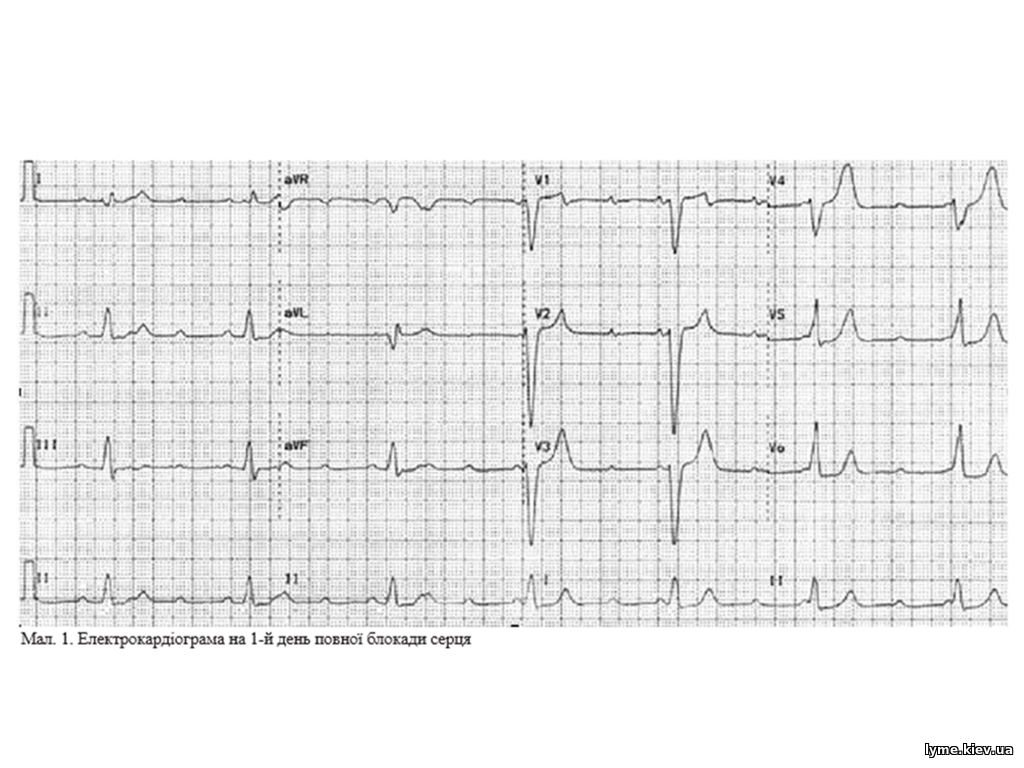 Електрокардіограма на 1-й день повної блокади серця