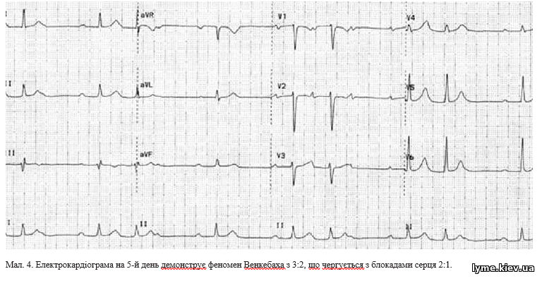 Електрокардіограма на 5-й день демонструє феномен Венкебаха з 3:2, що чергується з блокадами серця 2:1.
